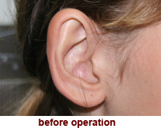 plastic-surgery-prominent-ear 